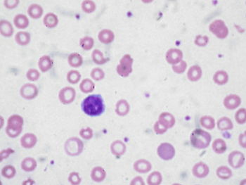 English: Peripheral blood film of a patient wi... English: Peripheral blood film of a patient wi...