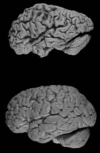 Healthy brain (bottom) versus brain of a donor...